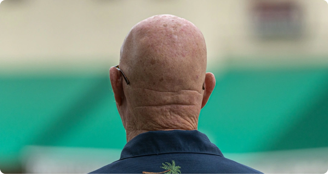 Foto plešatého muže