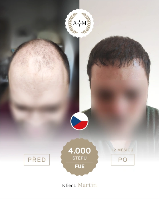 Foto před a po transplantaci vlasů