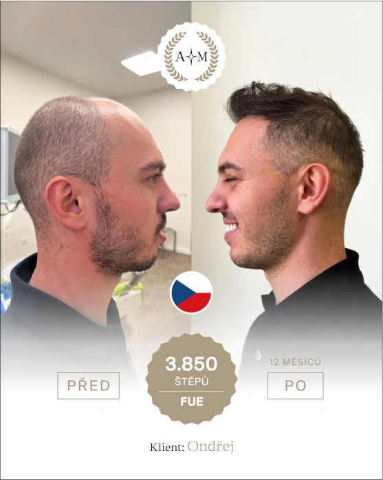 Foto před a po transplantaci vlasů