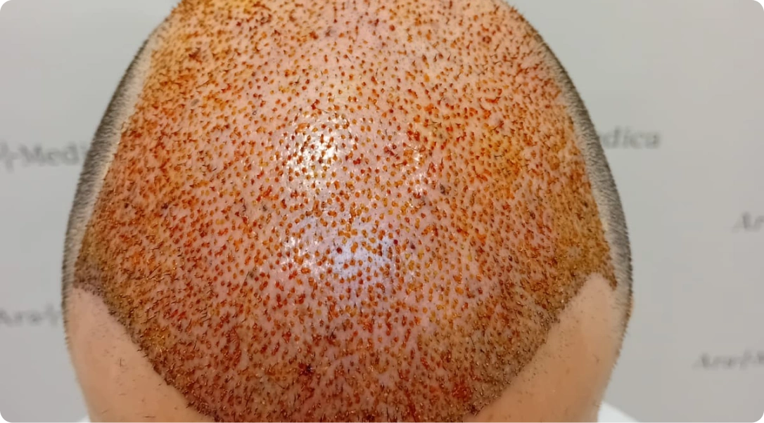 Foto těsně po transplantaci vlasů