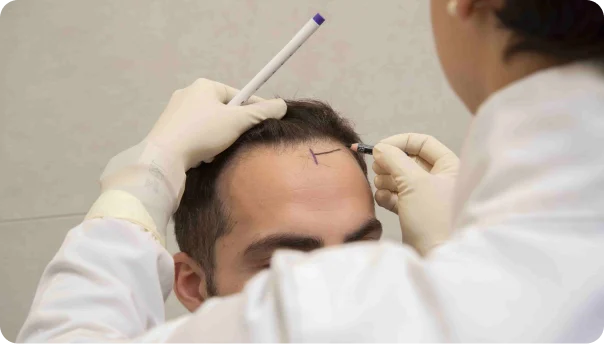 Jak se pozná kvalitní transplantace vlasů