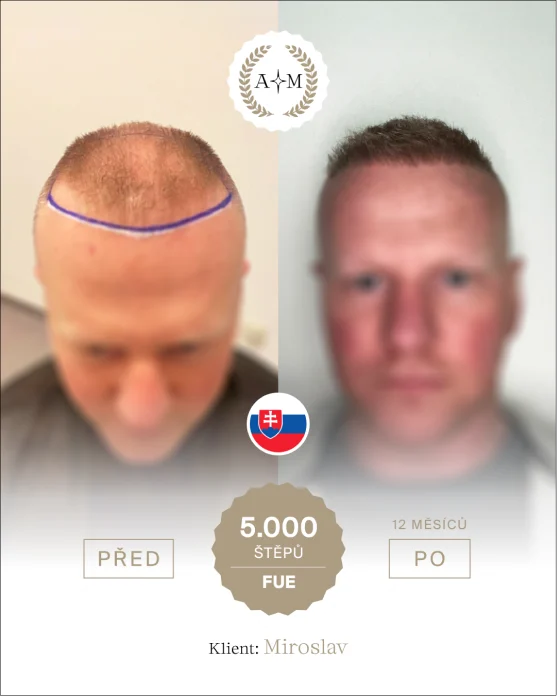 Foto před a po transplantaci vlasů
