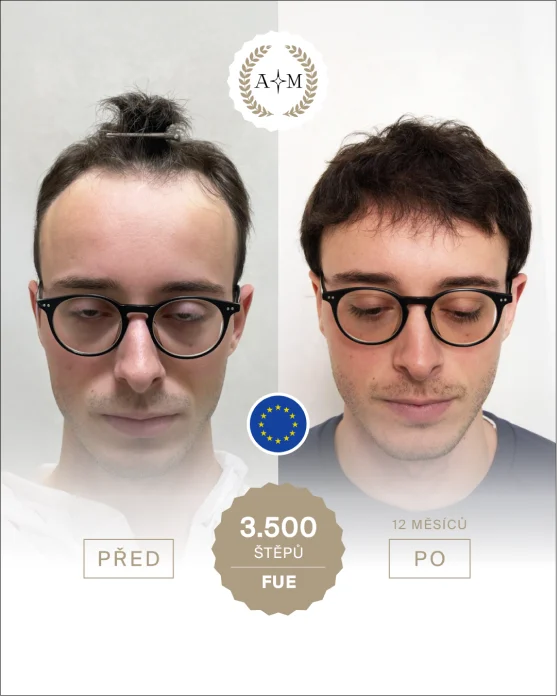Foto před a po transplantaci vlasů
