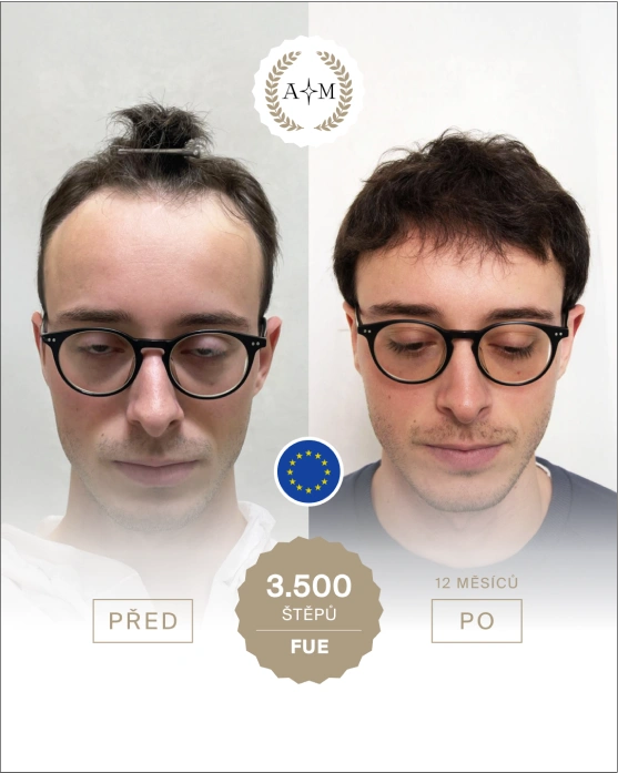 Foto před a po transplantaci vlasů