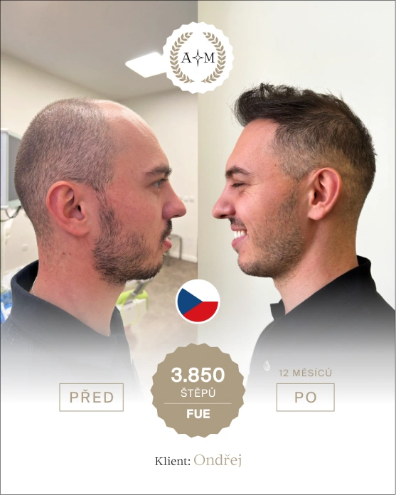Foto před a po transplantaci vlasů