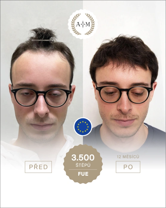 Foto před a po transplantaci vlasů