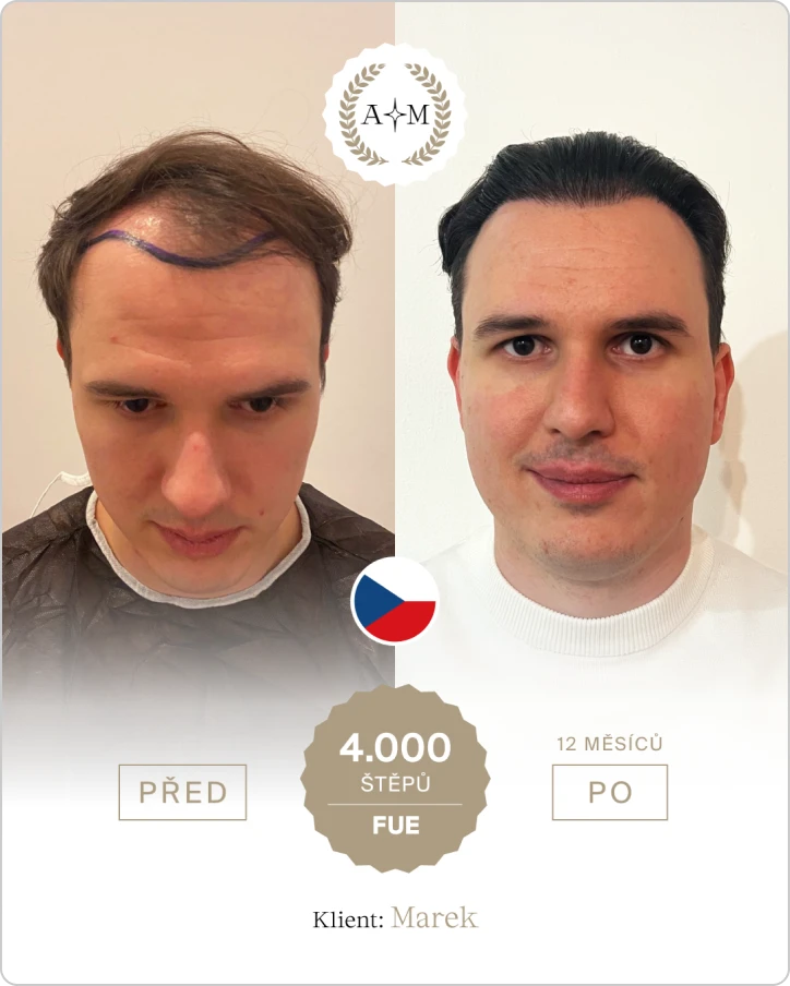 Foto před a po transplantaci vlasů