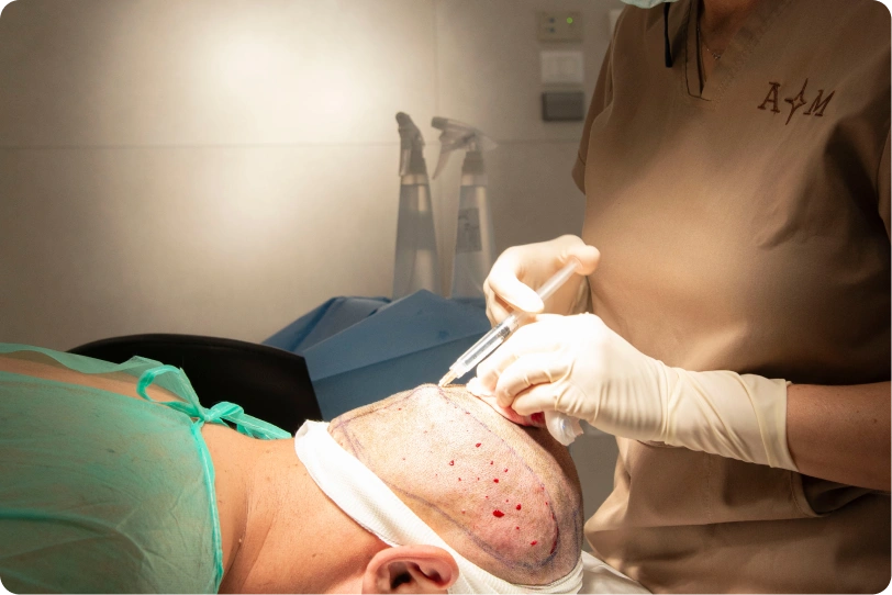 Foto anestezie při transplantaci vlasů