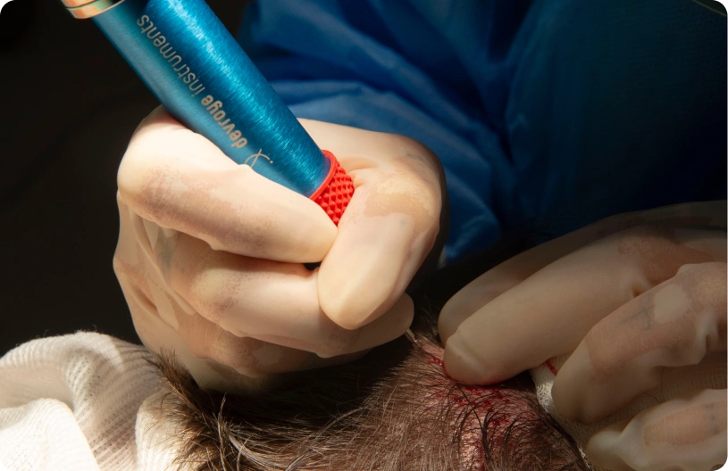 Transplantace vlasů pomocí Choi Pen
