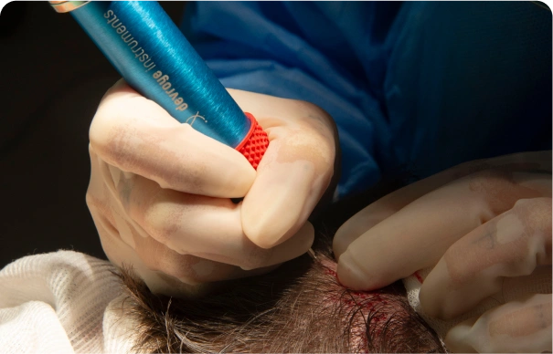 Přímá implantace