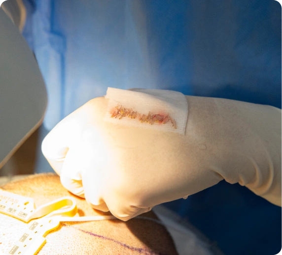 Implantace štěpů