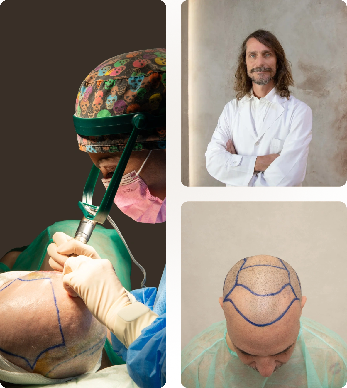 Foto transplantace vlasů ženy