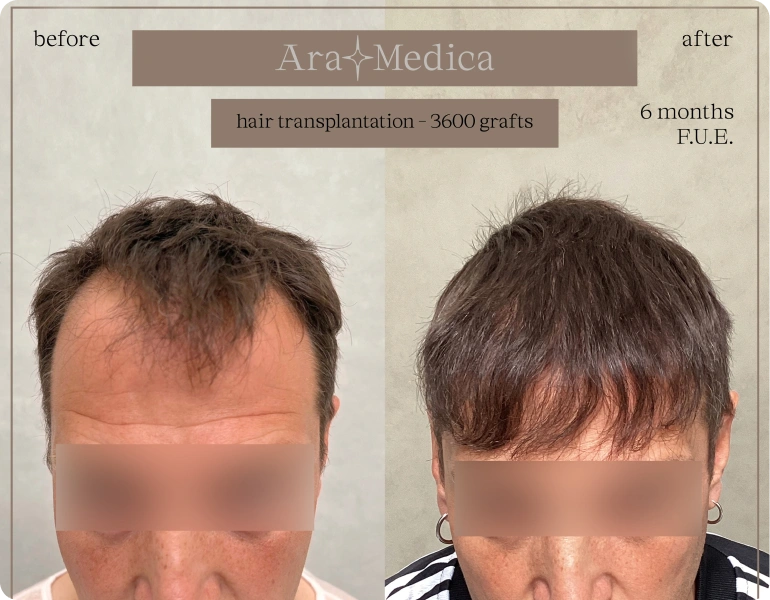 Foto před a po transplantaci vlasů