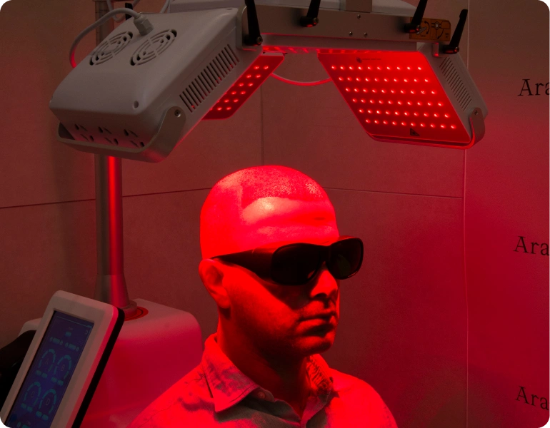 Foto regenerace po transplantaci vlasů
