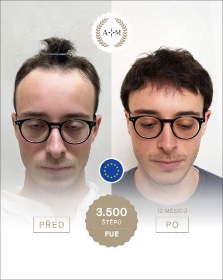 Foto před a po transplantaci vlasů