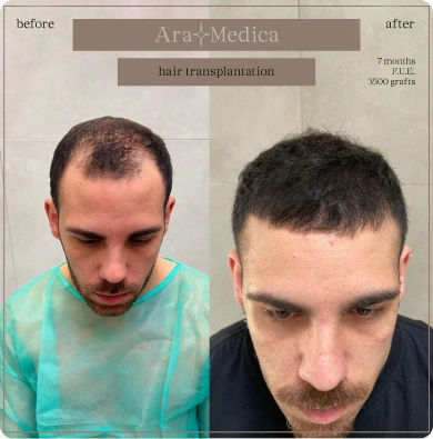 Výsledek transplantace vlasů