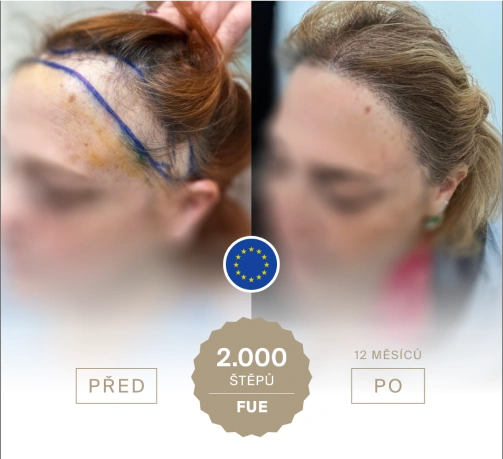 Před a po transplantaci naší klientky