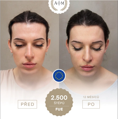 Před a po transplantaci naší klientky
